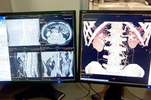 Photo of CT Coronary Angiography