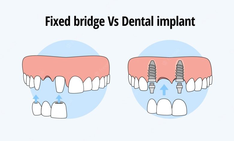 Photo of How To Choose between Dental Implants and Bridges